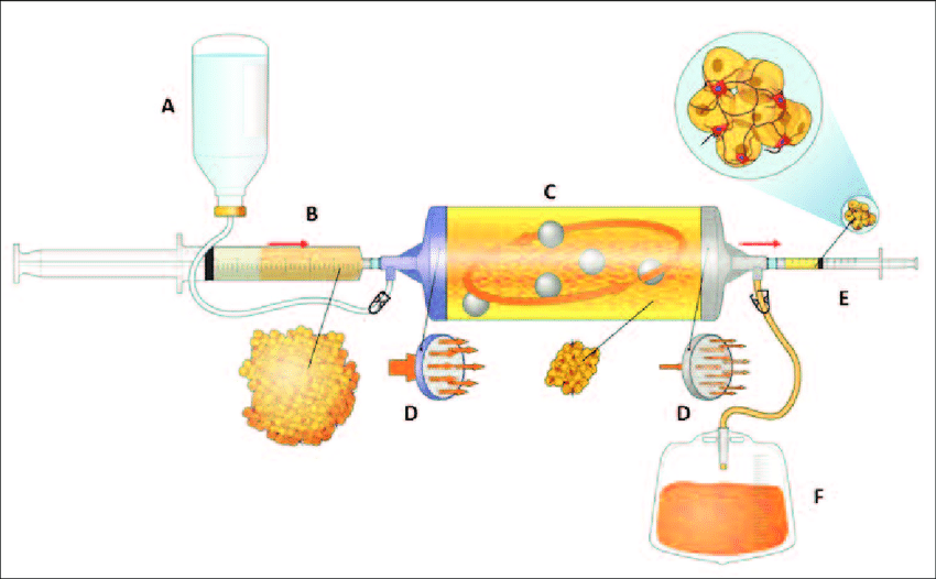 lipogems